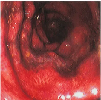 Fig. 1. Endoscopic finding of the duodenum. It shows mucosal redness and petechiae.