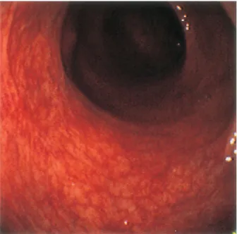 Fig. 4. Colonoscopic finding of the sigmoid colon 15 days after treatment with dapsone