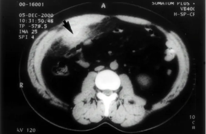 Fig. 2. Operative finding. A fish bone fragment (arrows) penetrated the colon wall and is surrounded by the inflammatory mass.