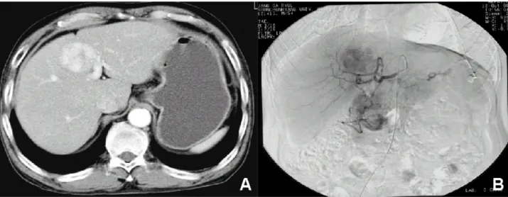 Fig. 1. Abdominal CT scan and hepatic angiogram on admission. (A) Abdominal CT shows a highly enhancing mass in the segment 4.