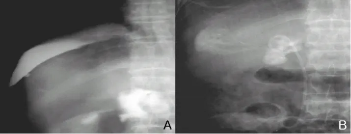 Fig. 3. Cholangiogram. (A) The contrast dye is observed in the area of hepatic dome. (B) The abnormal communication between the biliary duct and subcapsular space is shown.