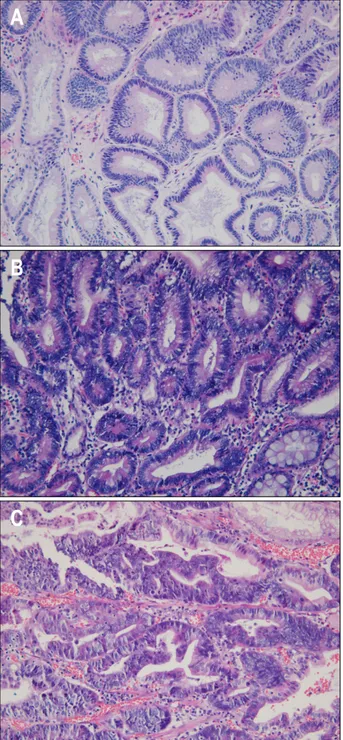 Fig.  1.  Pathologic  findings  after  endoscopic  sbumucosal  dis- dis-section:  low-grade  dysplasia  (A),  high-grade  dysplasia  (B),  and  mucosal  cancer  (C)  (H&amp;E  stain,  ×400).