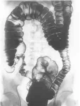 Fig. 2. Colonoscopic view. It shows multiple shallow ulcerations in the ileocecal valve.