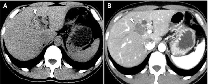 Fig.  1.  Pancreatico-bliliary  CT  and  MRCP  findings.  (A)  Non-contrast  image.  In  segment  IV/VIII  of  left  lobe  of  liver,  multiple  high  atte- atte-nuated  stones  were  found  (arrowhead)