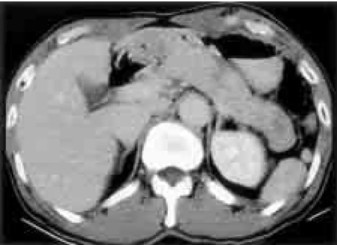 Fig. 1. Abdominal CT finding at admission. It shows diffuse enlargement of the pancreas.