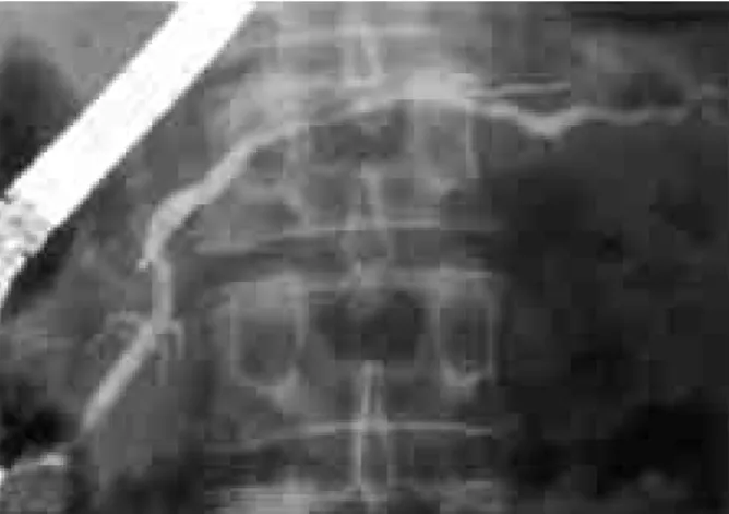 Fig. 4. Endoscopic retrograde pancreatography after steroid therapy.