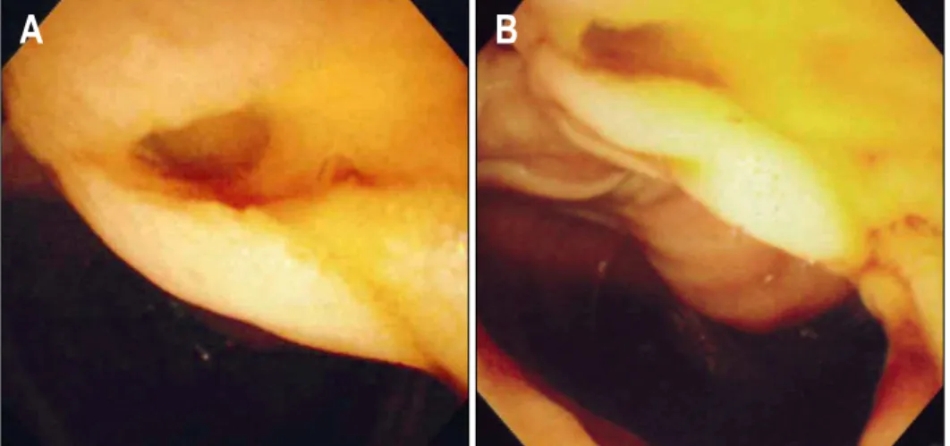 Fig.  2.  Duodenoscopic  findings. 