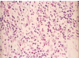 Fig. 4. Microscopic finding of the resected jejunum. Dense transmural infiltrates mainly consist of eosinophilic leukocytes, polymorphonuclear leucocytes, and plasma cells (H&amp;E stain, ×400).