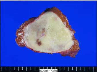 Fig.  3.  Macroscopic  view  of  the  resected  tumor  showed  a  well  demarcated  pale  yellow  to  grayish  soft  mass  with  focal  brownish  hemorrhage.