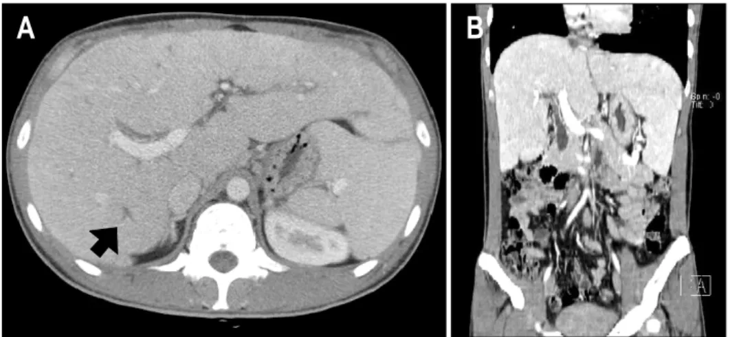 Fig.  1.  Abdominal  CT  scan  find- find-ing  (A,  axial  scan;  B,  coronal  multiplanar  reformation)