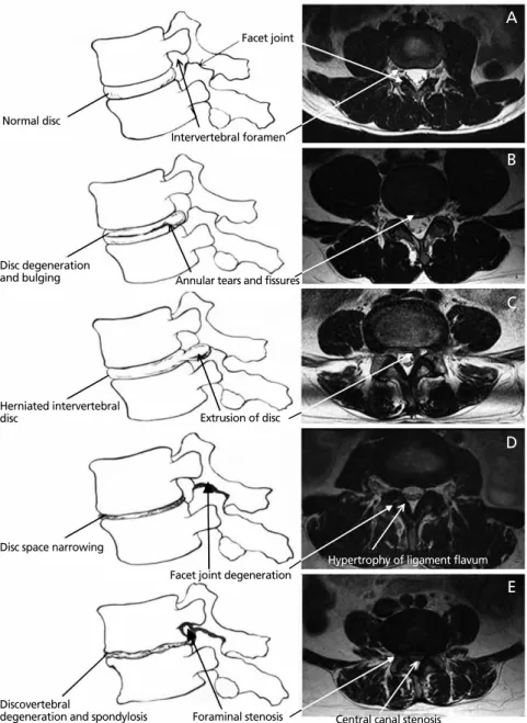 Figure 1.  The degenerative cascade of L4-5 spinal segment. (A) Normal disc, (B) degeneration of the interver- interver-tebral disc, (C) herniated interverinterver-tebral disc, (D) disc space narrowing and facet joint degeneration, and (E)  spinal stenosis