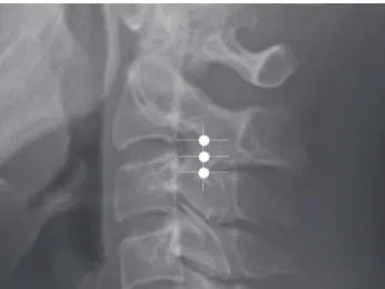 Figure 3.  Third occipital nerve block. A lateral view of the upper cervical spine  A
