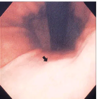 Fig. 2. Gastroscopic finding of the mid-body. Ulcer scar with irregular margin is observed on the posterior wall of the mid body at the time of first relapse (black arrow).