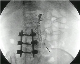 Fig. 2. Intra-operative endoscopic finding. Diffuse erythematous mucosal erosions with circular ulceration are shown.
