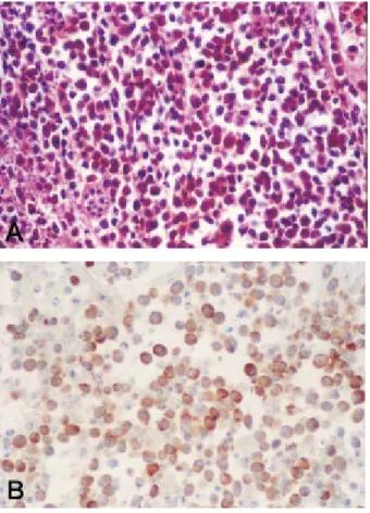 Fig. 2. Microscopic findings of resected specimen. (A) Atypical plasmacytoid cells are diffusely proliferated