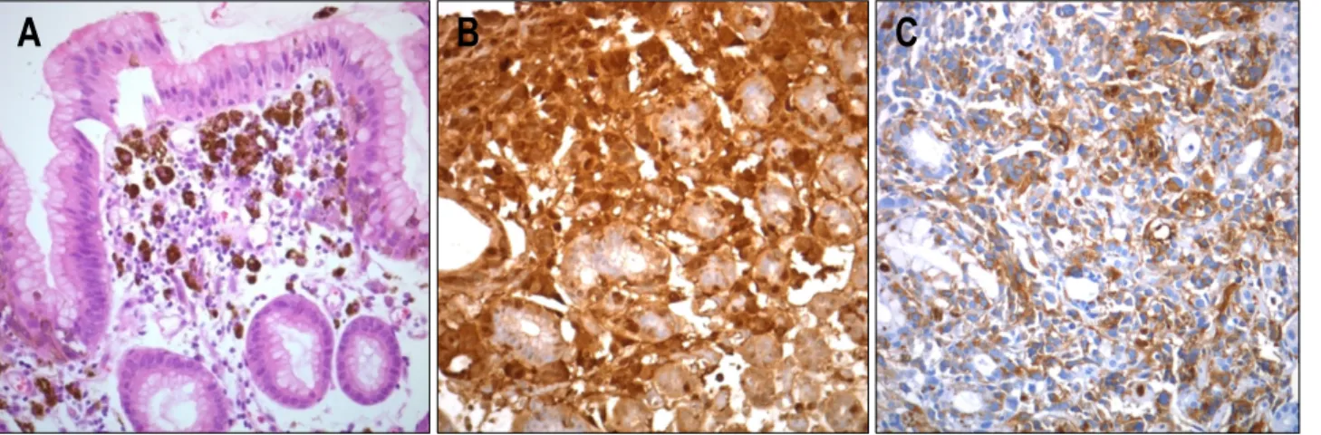 Fig.  3.  (A)  Pathologic  findings.  Malignant  melanoma  cells  infiltrated  the  lamina  propria  of  the  stomach  in  a  nesting  fashion  (H&amp;E  stain, 