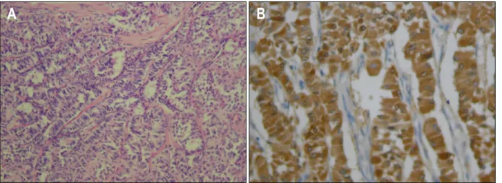 Fig.  3.  Microscopic  findings.  (A)  A  microscopic  photograph  (original  magnification  ×200,  H&amp;E  staining)  showed  that  the  tumor  cells  were  arranged  in  a  characteristic  Zellballen  pattern  with  anastomosing  sheets  around  a  deli