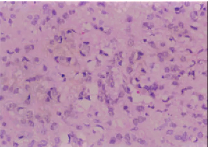 Fig. 1. Abdomen CT finding. Abdomen CT scan shows highly enhanced multiple masses in both lobes of the liver .
