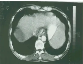 Fig. 3. Initial abdominal CT finding. Metastatic tumor thrombus is noted in the right atrium