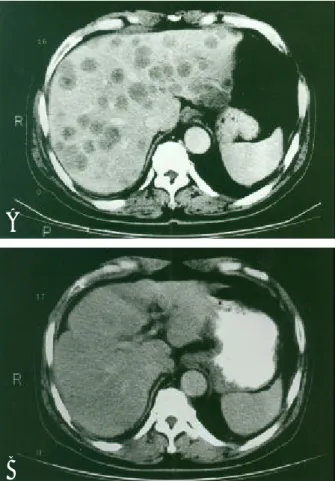 Fig. 1. CT scan of the abdomen. (A) It shows diffusely scattered multiple nodules in both lobes of the liver
