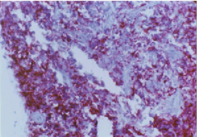 Fig. 3. Microscopic finding. The infiltrating lymphocytes are diffusely positive for B cell marker CD 20 (immunohistiochemical stain for CD20, ×200).