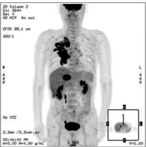 Fig.  5.  Whole  body  PET  CT.  It  showed  a  hypermetabolic  mass  (SUV=7.7)  in  central  portion  of  the  left  liver  segment  4