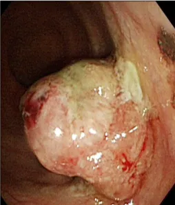 Fig.  1.  Endoscopic  finding  of  the  polypoid  mass.  There  was  about  3  cm  sized  fungating  mass  at  the  rectum
