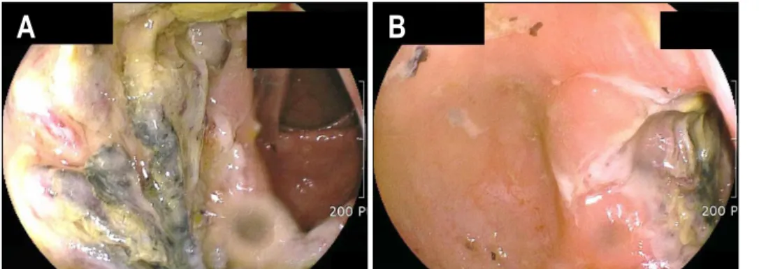 Fig.  1.  Colonoscopic  findings. 
