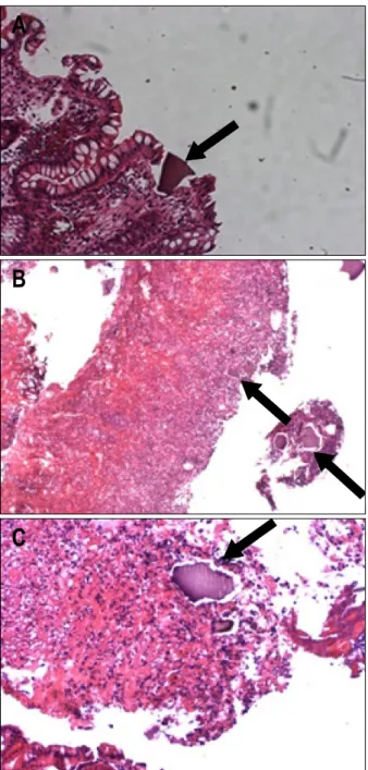 Fig.  2.  Microscopic  findings.  (A)  Biopsy  specimen  of  normal  mucosa  showed  basophilic  angulated  crystals  (arrow)  (H&amp;E  stain, 