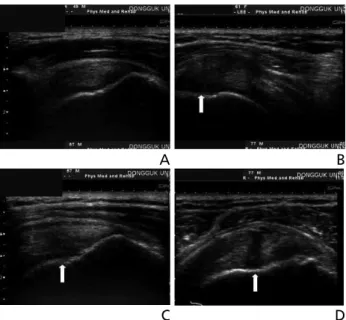 Figure 5.  Ultrasonography findings in rotator cuff diseases. (A) Normal  ultrasonography findings of supraspinatus tendon