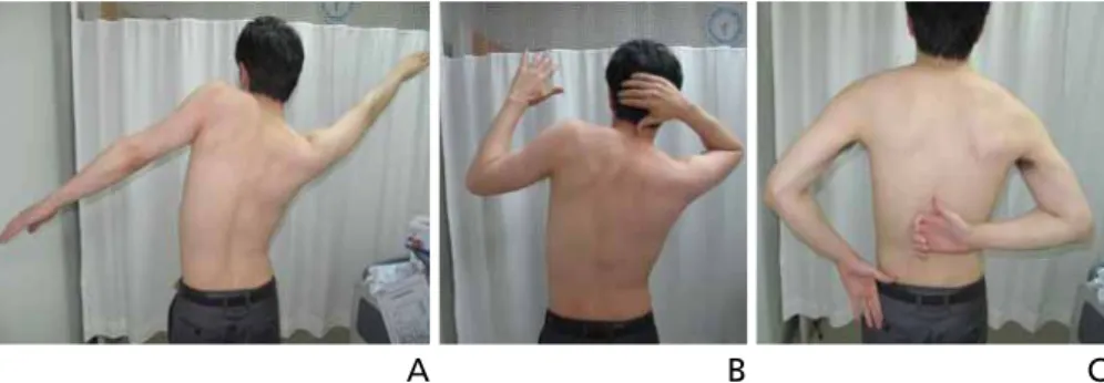 Figure 6.  Shoulder active range of motion in adhesive capsulitis. (A) Stiffness of shoulder abduction is shown in left  side with the rotation of scapula, which means the loss of scapulohumeral rhythm