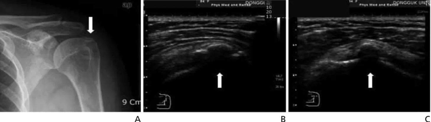 Figure 7.  Calcific tendinitis of glenohumeral joint. (A) Anteriorposterior radiography demonstrates a calcific deposition (arrow) in the supraspinatus tendon