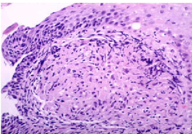 Fig. 2. Microscopic finding of an esophagoscopic biopsy specimen. It shows discrete granulomatous inflammation with epithelioid histiocytes and central caseous necrosis (H&amp;E stain, × 200).