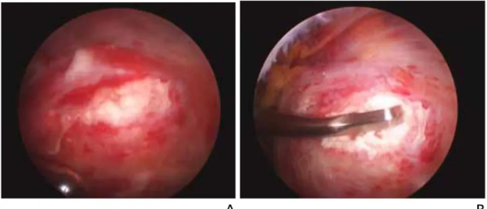 Figure 19.  (A) Calcific deposit in rotator cuff tendon. (B) Decompression of calcium.