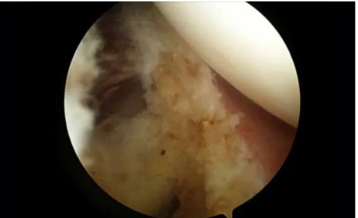 Figure 2.  Arthroscopic capsular release. Thickened capsule.