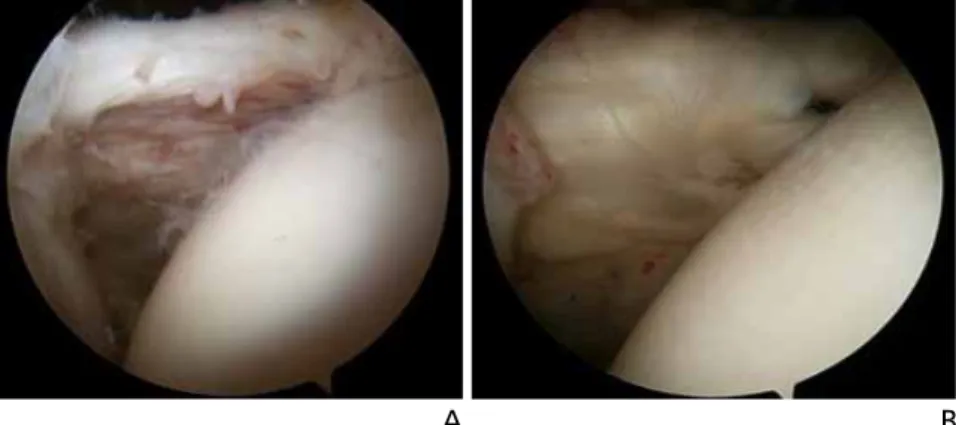 Figure 7.  Single-row rotator cuff repair.