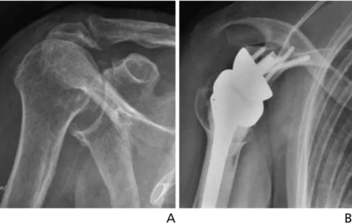 Figure 10.  (A) Cuff tear arthropathy . (B) Reverse total shoulder arthroplasty state.