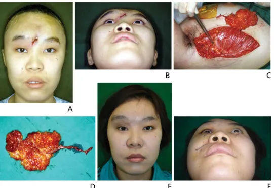 Figure 4. (A,B) A 22-year-old female with depressive deformity of forehead due to frontal sinusitis after traffic accident