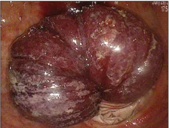 Fig.  1.  Endoscopic  finding  showed  a  congested  jejunal  segment  intussuscepted  into  the  the  stomach.