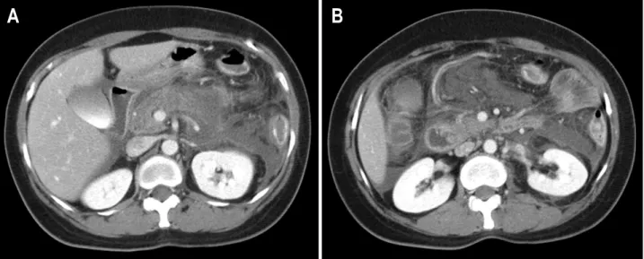 Fig.  2.  Abdominal  computed  tomography  (CT).  (A)  Initial  abdominal  CT  showed  diffuse  enlargement  of  pancreas  and  peripancreatic  fat  infiltration
