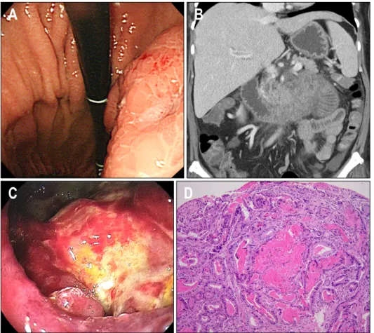 Fig.  1.  (A)  Endoscopically,  the  stomach  showed  surrounding   ede-matous  mucosa  and  central  erosion  with  extrinsic  compression  on  the  posterior  wall  of  the  upper  body