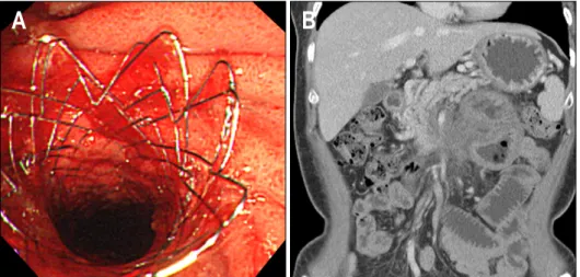 Fig.  2.  (A)  Stent  was  inserted  on  the  jejunal  obstruction  site  by  push  enteroscopy