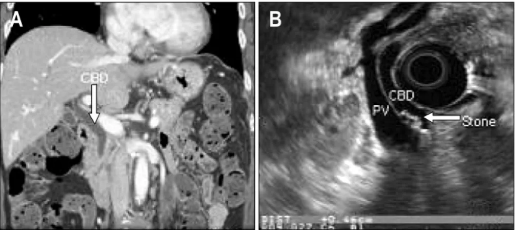 Table  3.  Diagnostic  Accuracy  of  US,  CT,  and  EUS  for  Diagnosing  the  CBD  Stone