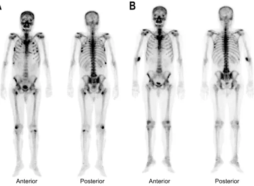 Fig.  1.  Whole  body  bone  scan  findings.  (A)  On  the  initial  bone  scan,  increased  hot  uptakes  were  noted  on  the  ribs,  both  femurs  and  left  proximal  tibia