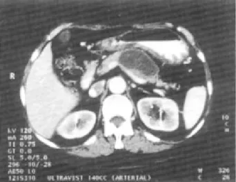 Fig. 1. Abdominal CT scan of case 1. It shows diffuse enlarge- enlarge-ment of the pancrease, necrosis of the body and peripancreatic fluid collection.