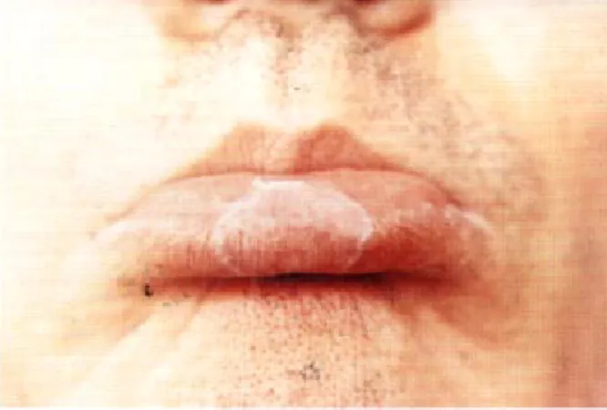 Fig 1. An erythematous erosive papule on lower lip. The patient shows a skin lesion on the center of the lower lip.