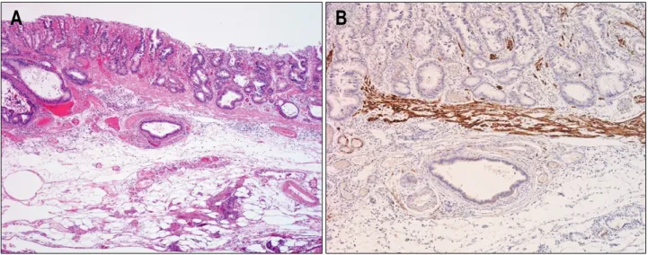 Fig.  4.  Herniated  gastric  mucosa  in  the  submucosa  (A;  H&amp;E,  ×200). 