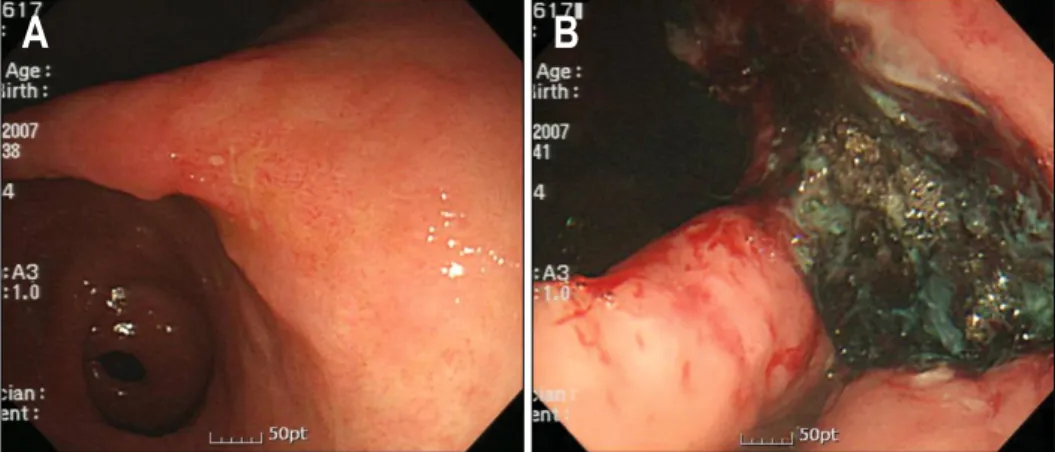 Fig.  2.  Chest  AP  views.  (A)  Patchy  consolidation  was  noted  in  the  diffuse  left  lung  field  after  procedure