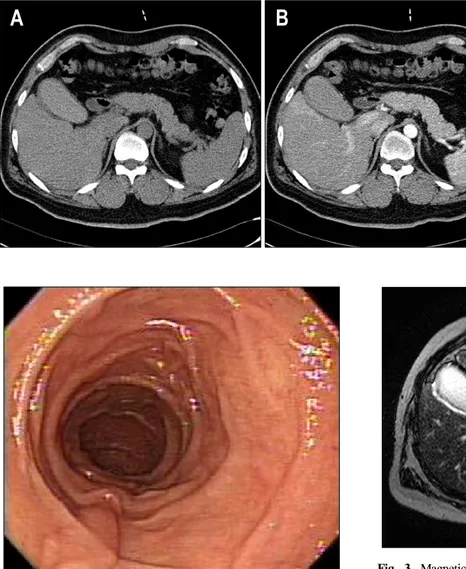 Fig.  1.  Computed  tomography  find- find-ing.  It  showed  highly  attenuated,  homogenous  materials  with  near  blood  density  in  the  gallbladder  at  both  pre-enhance  and  arterial  phase