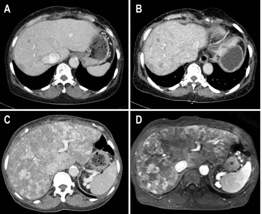 Fig.  1.  (A)  Three  years  ago,  CT  showed  multiple,  variable  sized,  and  ill-defined  low  density  nodule  scattering  through  entire  liver